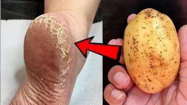 Recette naturelle pour éliminer les talons fissurés