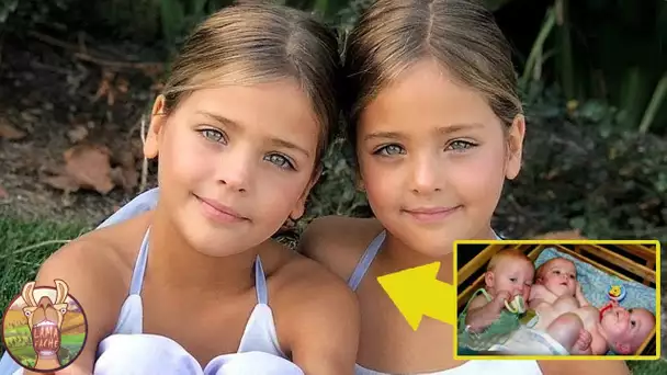 Ces soeurs siamoises ont été abandonnées par leurs parents. Ce qu‘elles sont devenues vous choquera!