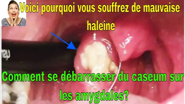 Voici pourquoi vous souffrez de mauvaise haleine Comment se débarrasser du caseum sur les amygdales?