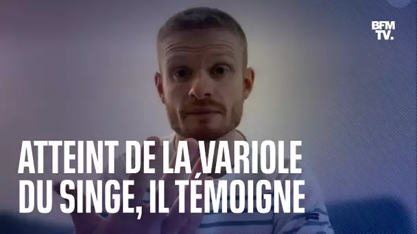 Atteint de la variole du singe, Corentin témoigne