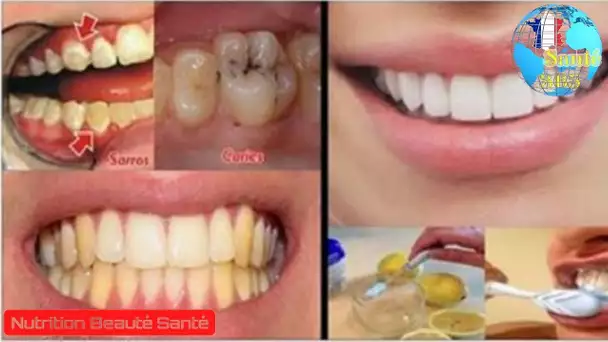 Dites adieu aux caries, au tartre et aux dents jaunes avec cette recette