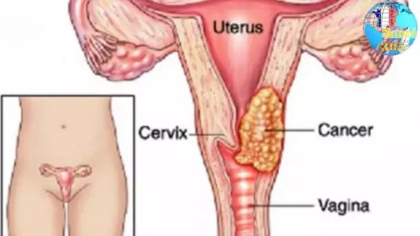 Cancer du col de l&#039;utérus : du diagnostic au traitement