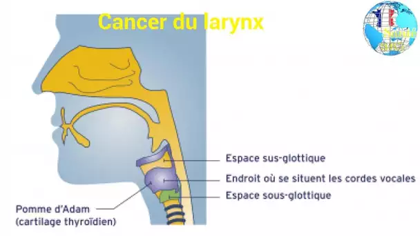 Cancer du larynx