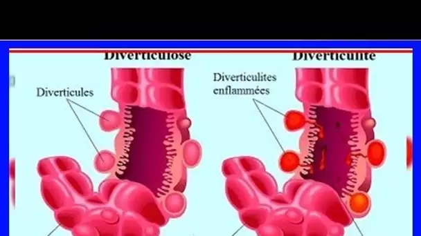 Voici que sont vraiment la diverticulose et la diverticulite, et comment les traiter …