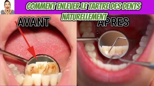 Comment enlever le tartre sur les dents NATURELLEMENT ?