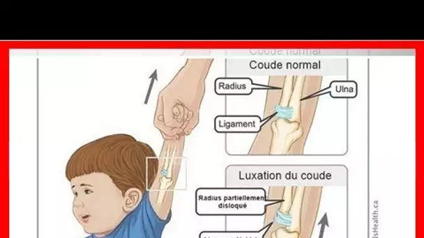 Luxation du coude chez nos enfants : Attention !