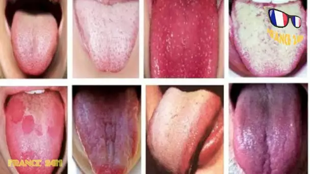 Cette couleur de langue peut révéler un cancer. Faites attention !