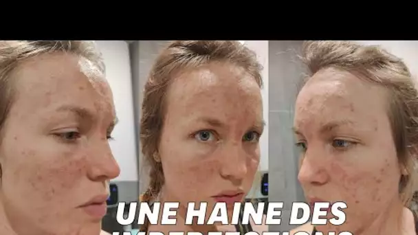 Atteinte de dermatillomanie pendant 15 ans, elle raconte ce toc méconnu qui ravage la peau