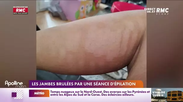 Des jambes brûlées après une séance d'épilation définitive