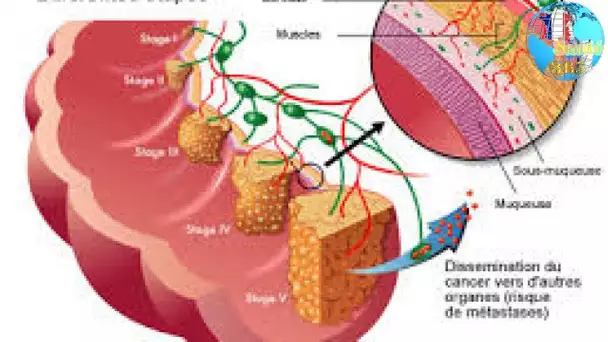 Cancer de l’intestin grêle