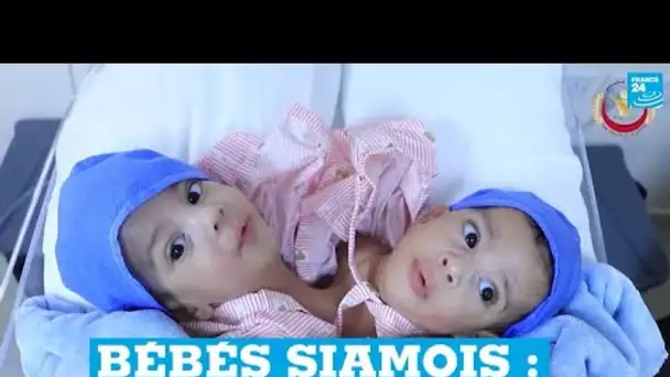 Bébés siamois : nés au Yémen, ils sont séparés avec succès en Jordanie • FRANCE 24