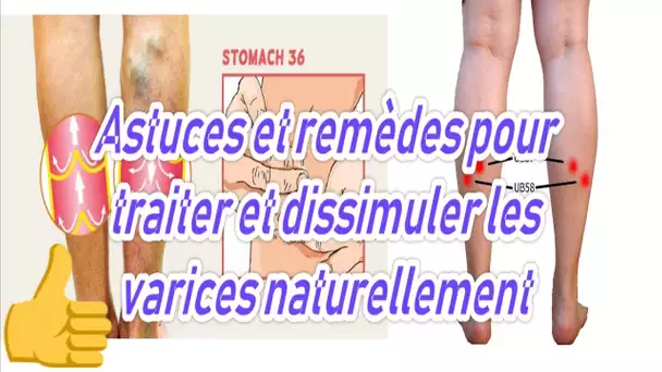 Astuces et remèdes pour traiter et dissimuler les varices naturellement