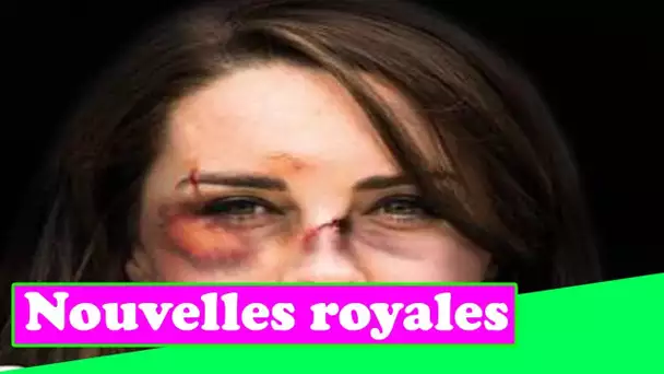 Fur,y comme image falsifiée de Kate Middleton « meurtrie » utilisée dans une campagne contre la viol