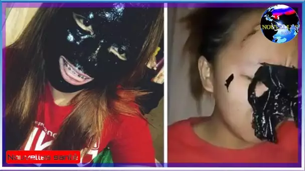 Cette jeune fille a perdu ses sourcils quand elle a utilisé le célébre masque anti-points noirs