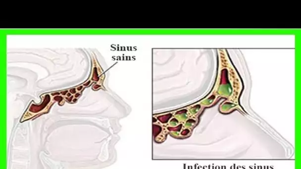 Comment soulager votre infection des sinus en 20 secondes