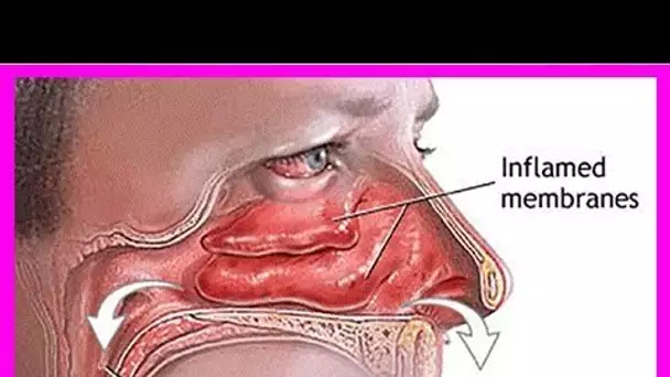 2 Astuces ingénieuses : Voici comment dégager vos sinus en 20 secondes en utilisant vos doigts seul