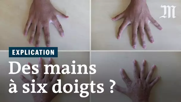 Six doigts à chaque main : une étude se penche sur la polydactylie