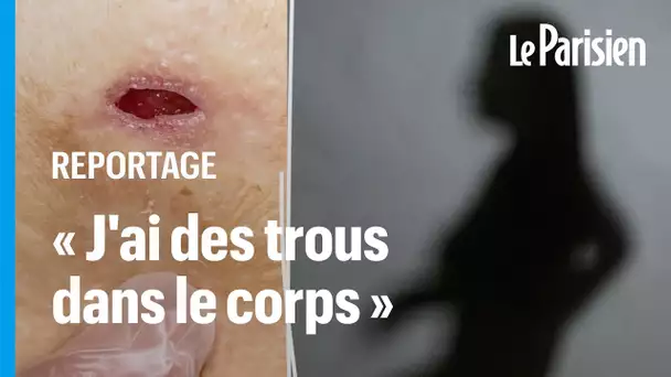 Les ravages des injections sauvages d’acide hyaluronique