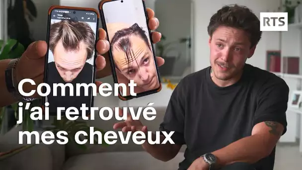 les greffes de cheveux séduisent de plus en plus face à la calvitie