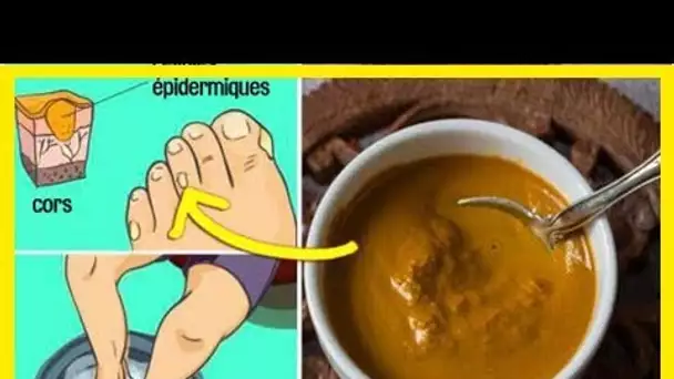 2 astuces faciles et MIRACULEUSES pour se débarrasser des cors aux pieds rapidement !