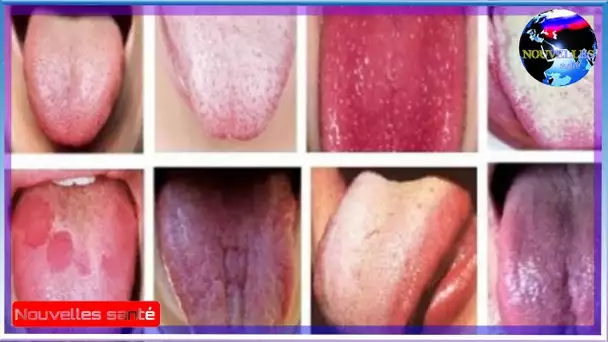 La couleur de votre langue révèle la santé