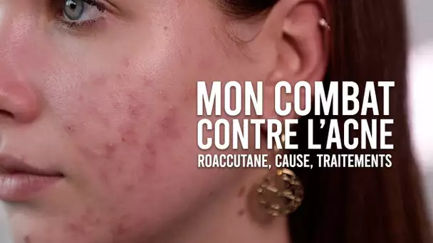 MON COMBAT CONTRE L&#039;ACNÉ (CAUSE, TRAITEMENTS & MON AVIS SUR ROACCUTANE)