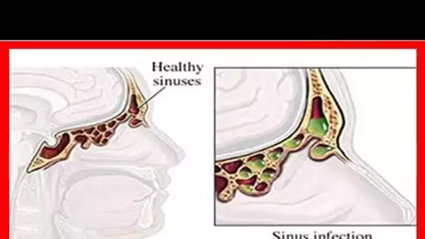 Comment soulager votre infection des sinus en 20 secondes ?