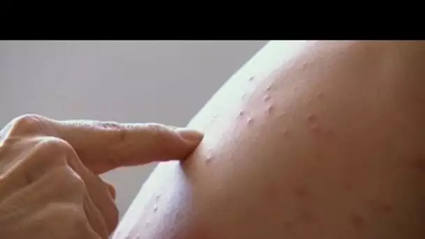 Épidémie de varicelle en région Centre-Val de Loire