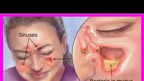 Soignez une infection du Sinus en 20 secondes avec une Méthode Simple à base d’un ingrédient que to