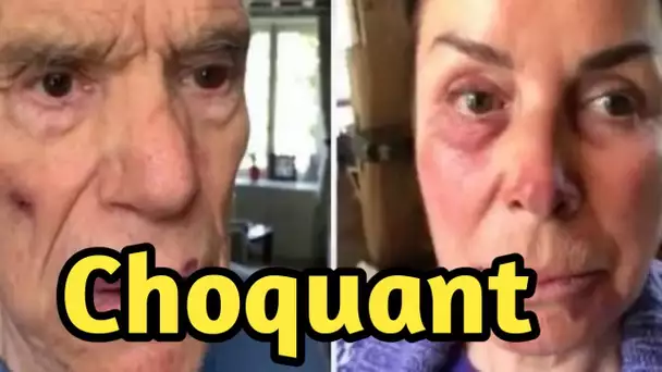 Agression de Bernard Tapie et sa femme Dominique : photos de leurs visages tuméfiés