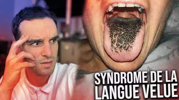Les plus étranges maladies (syndrome de la langue velue)