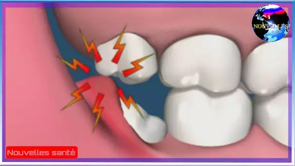 Les choses à savoir autour des dents de sagesse vous sont cachées