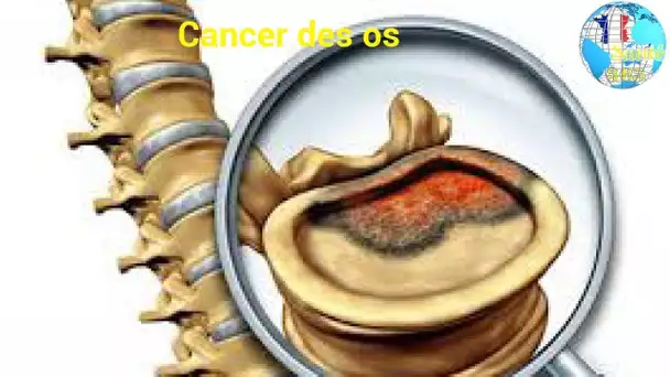 Cancer des os