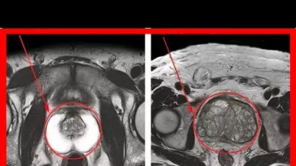 Voici comment rétrécir naturellement une prostate … 9 Remèdes naturels de l’hypertrophie bénigne pr