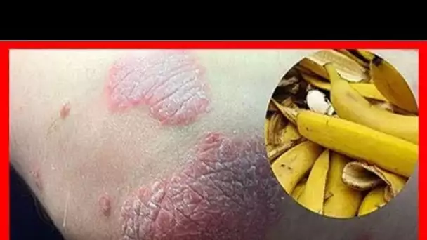 Efficace contre les rides, les verrues, le psoriasis … Ne jetez JAMAIS la peau de banane !