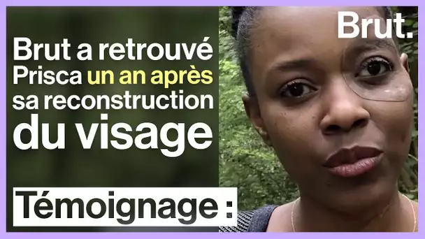 Reconstruction du visage : 1 an après, Prisca et sa prothèse d'œil