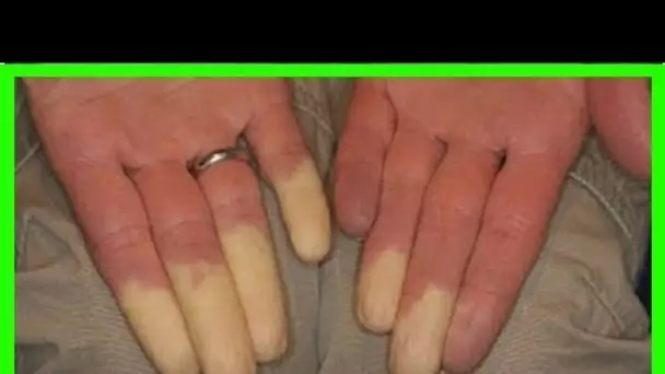 Le syndrome de Raynaud : la maladie qui engourdit vos doigts et changent leur couleur !