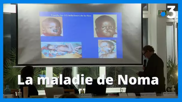 La maladie de Noma : l'association Sourire un jour, redonne le sourire à des enfants