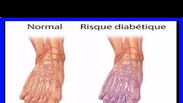 Voici comment guérir un pied diabétique naturellement … (Mise au point et Recette à préparer)