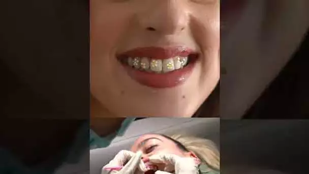 L'art des bijoux dentaires