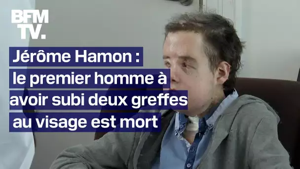 Jérôme Hamon, le premier homme avec deux greffes au visage est mort