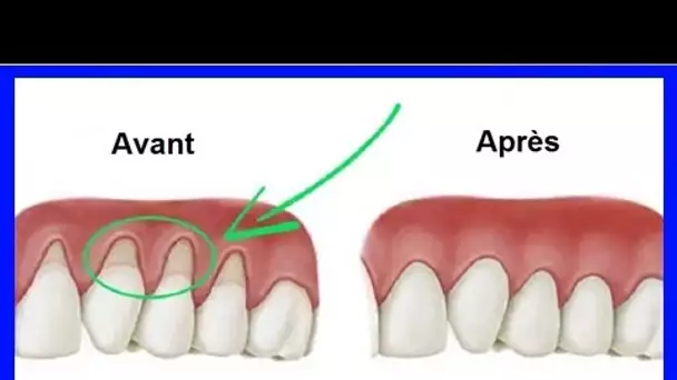 3 remèdes naturels pour réparer les gencives qui se rétractent !
