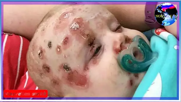 Couverte de vésicules après avoir attrapé la varicelle - la mère avertit tous les parents
