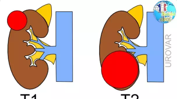 Cancer du rein traitement