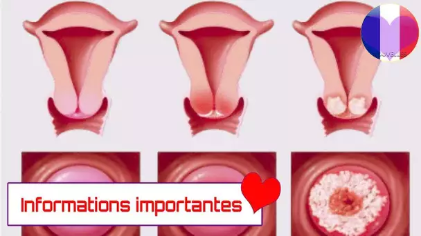 Voici les symptômes du cancer du col de l’utérus, chaque femme doit savoir cela !