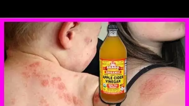 Utilisez le vinaigre de cidre pour traiter l’eczéma, c’est incroyablement efficace