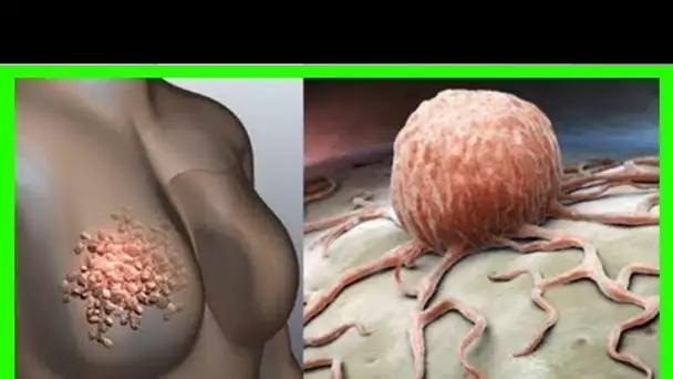 Les femmes doivent arrêter d’ignorer ces 5 signes alarmants du cancer du sein !