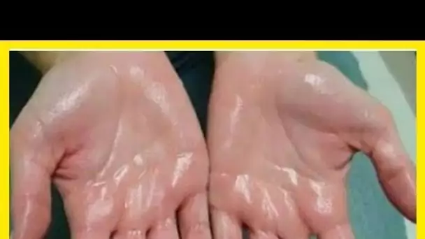 Hyperhidrose : Voici Comment mettre fin à la transpiration au niveau des mains et des pieds …