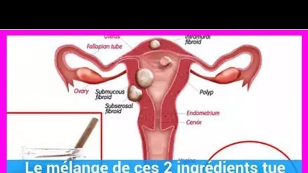 Un mélange de ces 2 ingrédients tue les kystes et les fibromes !