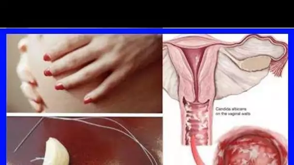 Comment guérir une infection vaginale à levures (même si vous êtes enceinte ) et sans avoir recours